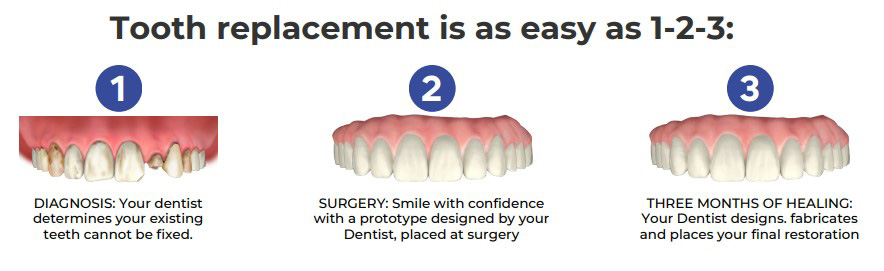 Simple tooth replacement process illustrated, showcasing ease in Atlanta, GA