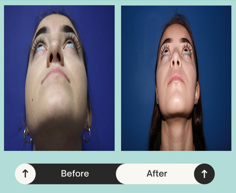 Before & after image of a woman who got jaw alignment treatment in Atlanta, GA 