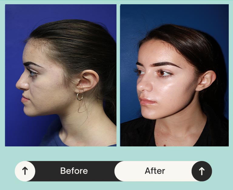 Side view of a woman who got jaw alignment treatment in Atlanta, GA 