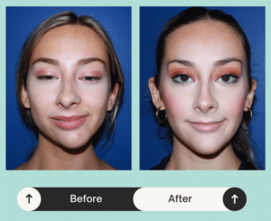 Before & after image of Anna, who got facial reconstruction surgery in Atlanta, GA 