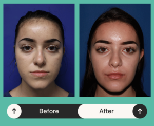 Before & after image of a woman who got facial reconstruction surgery in Atlanta, GA 