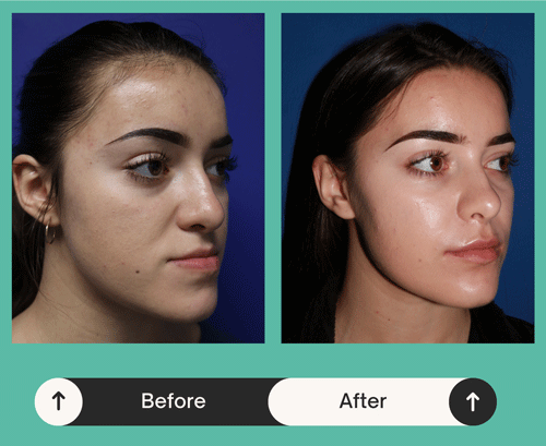 Before & after image of a woman named Melissa who got jaw alignment treatment in Atlanta, GA 