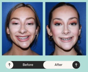 Before & after image of a woman who got teeth alignment treatment in Atlanta, GA 