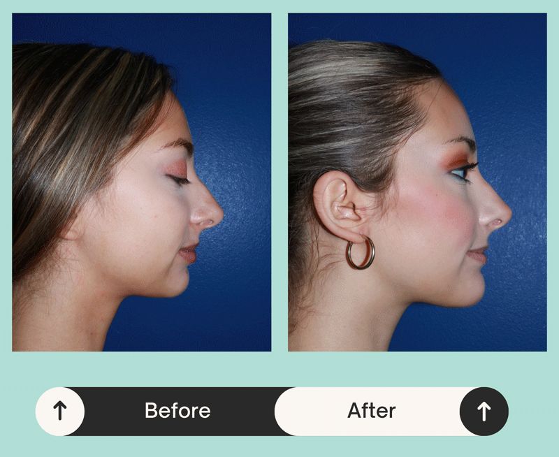 Comparison of a patient's nose before and after undergoing rhinoplasty in Atlanta, GA