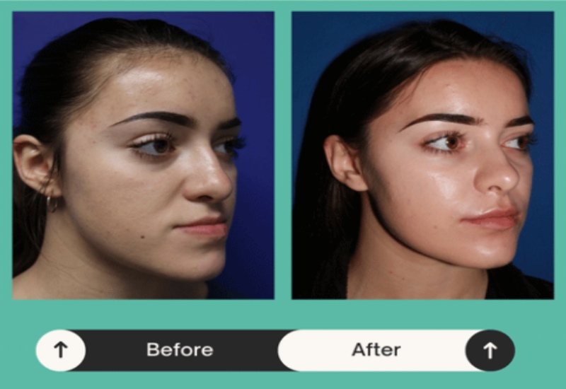 Before and after comparison showing the results of facial treatment in Atlanta, GA