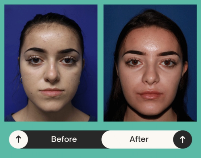 Before and after results of the facial reconstruction procedure in Atlanta, GA